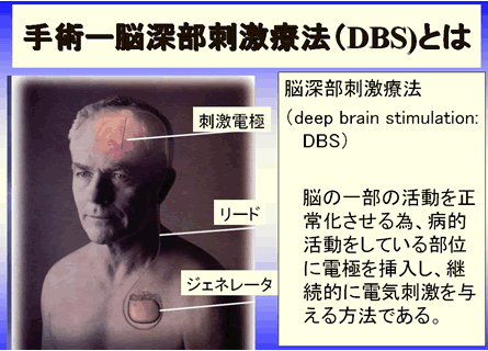 手術ー脳深部刺激療法（DBS)とは