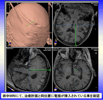 術中MRIにて、治療計画と同位置に電極が挿入されている事を確認