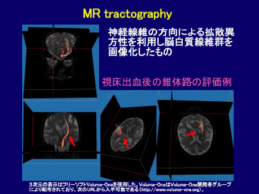 MR tractography
