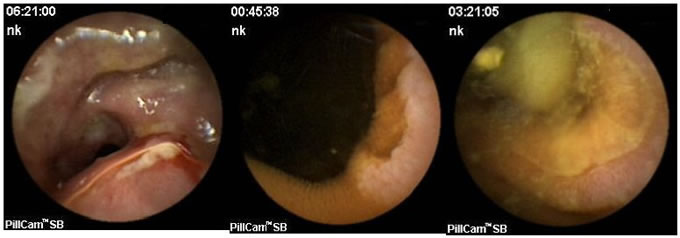 悪性リンパ腫による狭窄部と潰瘍性病変のカプセル内視鏡画像