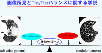 画像所見とTh1/Th2バランスに関する学説