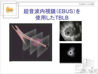 超音波内視鏡（EBUS）を使用したTBLB
