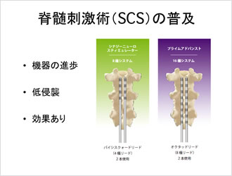 脊髄刺激術（SCS）の普及