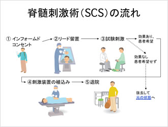 脊髄刺激術（SCS）の流れ
