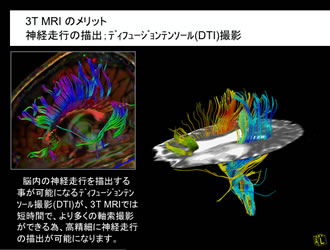 3T MRIのメリット 神経走行の描出：ディフュージョンテンソール（DTI）撮影