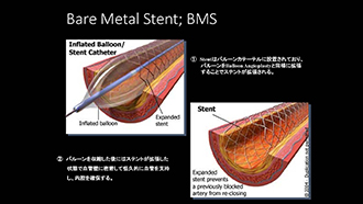 Bare Metal Stent; BMS