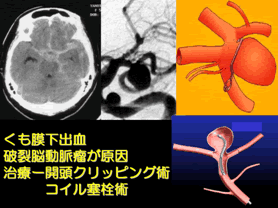 くも膜下出血　破裂脳動脈瘤が原因　治療-開頭クリッピング術コイル塞栓術