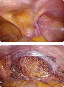 腹腔鏡下鼠径ヘルニア手術(TAPP)