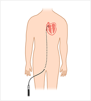 心臓カテーテルアブレーション治療（経皮的心筋焼灼術）｜名古屋