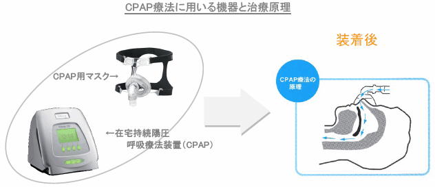 CPAP両方に用いる機器と治療原理